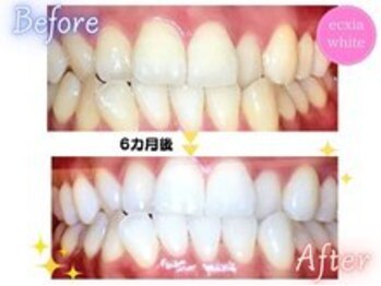エクシアホワイトニング 前橋店/セルフホワイトニング　6ヶ月後