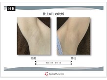 アンス(Ance)/脱毛ビフォア♪