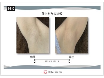 アンス(Ance)/脱毛ビフォア♪