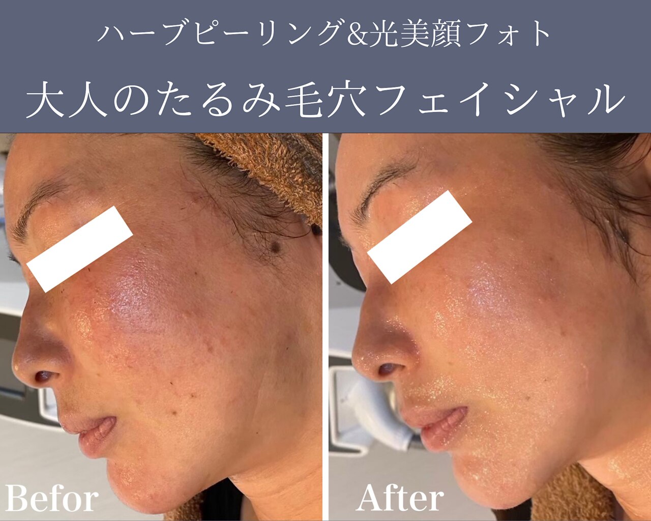 【４週間以内クーポン】毛穴・たるみケア/ハーブピーリング+光美顔フォト