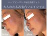 【４週間以内クーポン】毛穴・たるみケア/ハーブピーリング+光美顔フォト