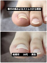巻き爪じゅん 千葉駅前店/巻爪による痛みのストレス解放！