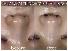 ビノスビューティー(vinos.beauty)/症例写真　ハーブトリートメント