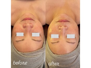 リノ(Lino)/プラズマbefore after