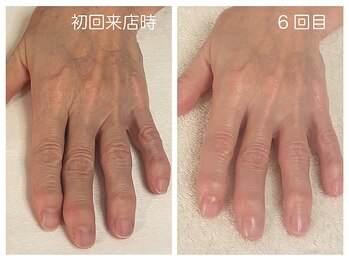 キレイテ 福岡天神店/くすみ、血管が気になる