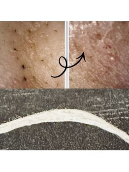 フルーヴ ルフレ(Fleuve Reflet)/肌質改善ワックス脱毛＆毛穴ケア