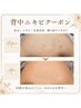 初回体験【背中を隠す人生卒業】背中ニキビ・赤み跡集中ケア¥18000→¥12800
