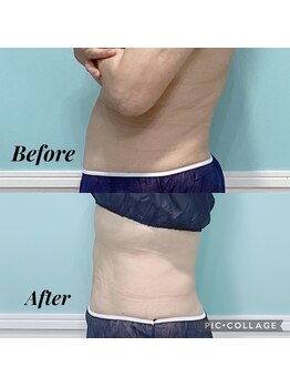 ビーナスアイスブルー(Venus ICE BLUE)/脂肪冷却3回施術