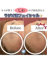 ミムー/before／after