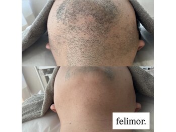 フェリモール(Felimor.)/メンズ脱毛