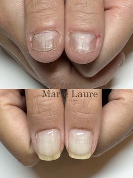 マリーロール 淀屋橋本店(Marie Laure)/深爪矯正/自爪育成/ネイルケア