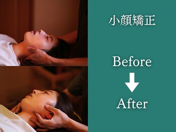 カケル(KAKERU)/小顔矯正