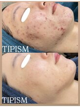 ムーンリズム(Moonlism)/【TIPハーブ症例】ニキビ/肌荒れ