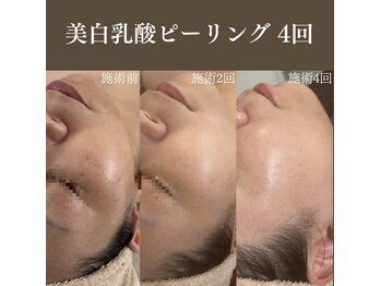 サロンドペシェ(salon de peche)/乳酸ピーリング4回つるんと美白