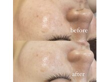 レシェルサロン(Lechelle Salon)/ハーブピーリング