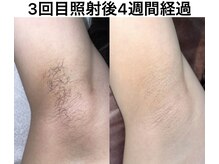 リオル(ReOlu)の雰囲気（全身 VIO顔込みで¥5,000～¥10,000　）