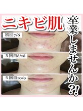 アルムダアクア 天王寺店(Aleumda AQUA)/ハーブピーリング/大阪/天王寺