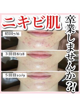 アルムダアクア 天王寺店(Aleumda AQUA)/ハーブピーリング/大阪/天王寺