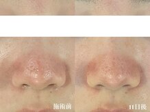 ランプ(LAMP)/毛穴の開きが気になる方に