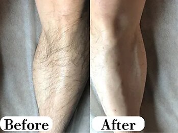 ビースキン 広島(BE:SKIN)/脚/全身脱毛/フェイシャル/VIO