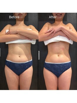 ルネアススパ 南青山(Lune’as Spa)/《WINBACK》くびれ