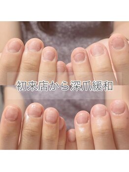 キュア(Cure.)/ご来店当日から深爪が緩和
