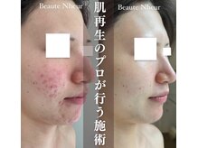 ボーテヌール(Beaute Nheur)/ララピーリング