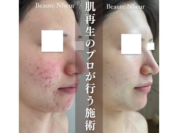 ボーテヌール(Beaute Nheur)/ララピーリング