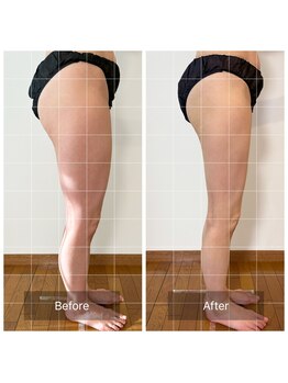 ミミ トータルケア(mimi Total care)の写真/夏美脚で視線独占☆神経からのアプローチで筋機能を最適化◎EMS&美脚コルギでむくみ・歪みを徹底改善◎