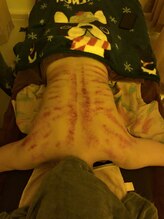 本格中国式リラクゼーションマッサージ 唐/背中カッサ