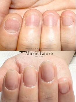 マリーロール 梅田店(Marie Laure)/自爪育成/深爪矯正/ネイルケア
