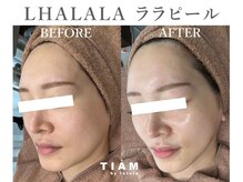 ティアム バイ テトテ 神戸三宮(TIAM by tetote)の雰囲気（ララピール導入☆角栓,皮脂,毛穴汚れ除去,赤み,ニキビケア）