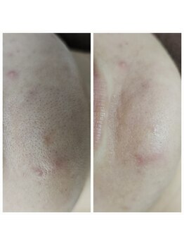 エターナル(Eternal)/マスクで荒れた顎にも