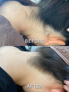 プーラビーダ 川西能勢口店(PuraVida)/うなじ脱毛