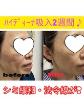 ヨサパーク アエル(YOSA PARK AELL)/高濃度水素・酸素吸入30分だけ！