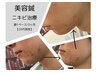 【男性肌荒れ専用】美容鍼¥5500→¥3300(税込)肌キメチェック込み！