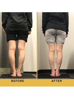 ベル/【20代会員様】O脚矯正の変化