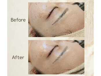 アンダブル(Andouble)/ビフォーアフター(お顔剃り)