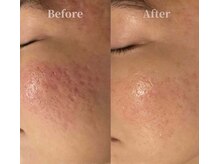 セラ(SERA)の雰囲気（【サーマトリックス】毛穴・赤み・肌質改善！）