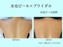 プレリー 自由が丘店/水光ピールスキン