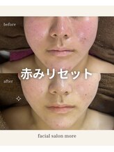 ヨサ モア(yosa more)/【10代顔の赤み】BeforeAfter