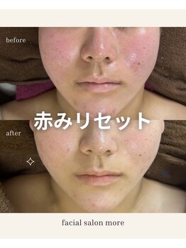 ヨサ モア(yosa more)/【10代顔の赤み】BeforeAfter