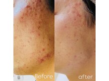 メンズエムボーテ 太田店(Men's M BEAUTE33)の雰囲気(【太田市/メンズフェイシャル】幹細胞°運輸でニキビケア)