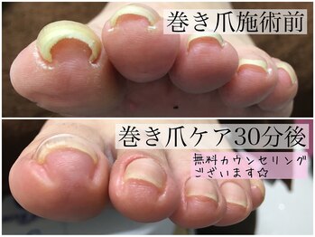 巻き爪専門スタッフ施術効果◎