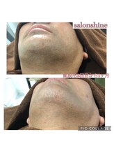 サロンシャイン(Salon Shine)/ヒゲ脱毛三回目