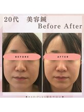 ハリプラス(HariPlus)/美容鍼ビフォーアフター