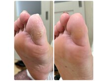 乾燥・冷えで角質が付きやすくなる冬こそ、足を労わる角質ケア！