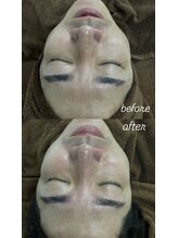 キュル(Kyul)/REVIハーブピーリング