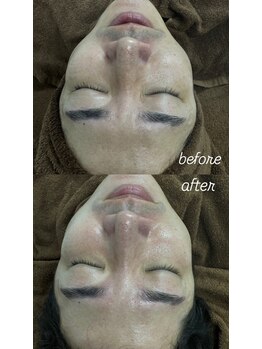 キュル(Kyul)/REVIハーブピーリング