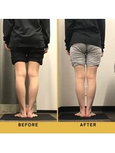 ベル/【20代会員様】O脚矯正の変化